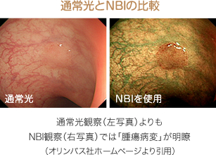 通常光とNBIの比較